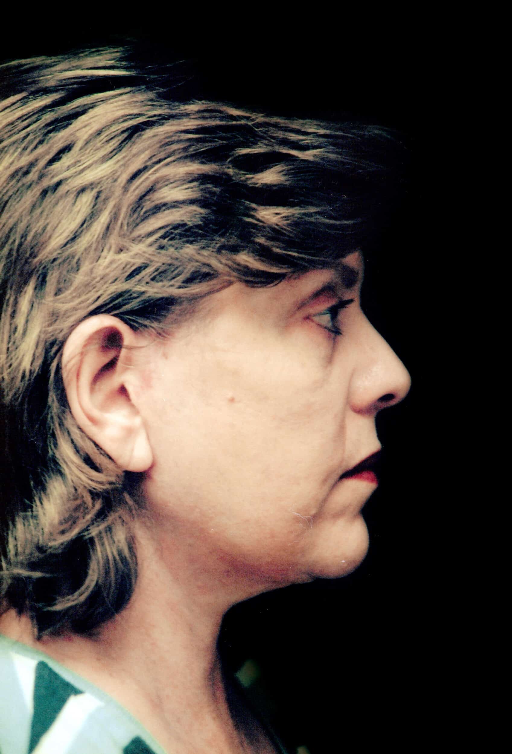 After Image: Face/Neck Lift - right-side