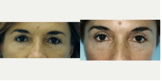 before & after image of Blepharoplasty surgery miami FL