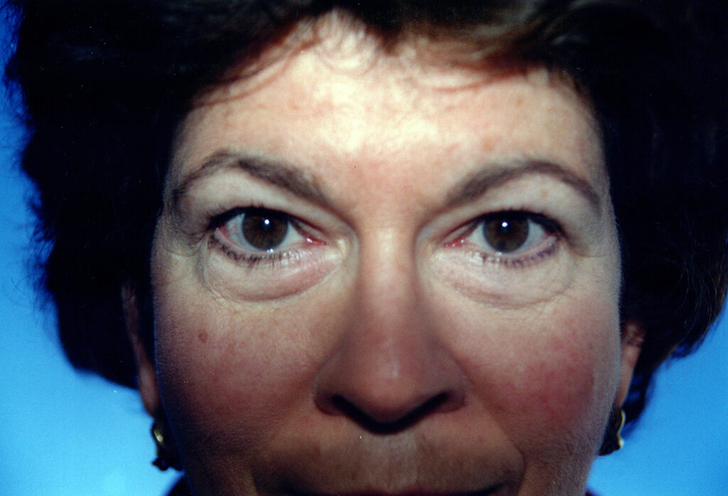 Before Image: Blepharoplasty - front