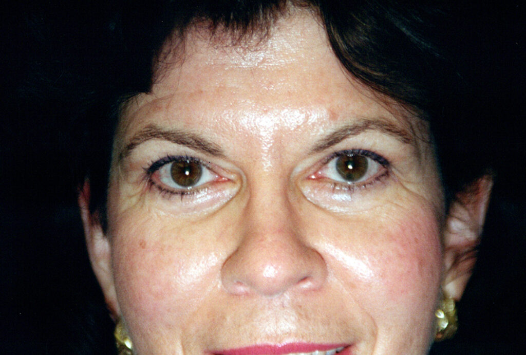 After Image: Blepharoplasty - front