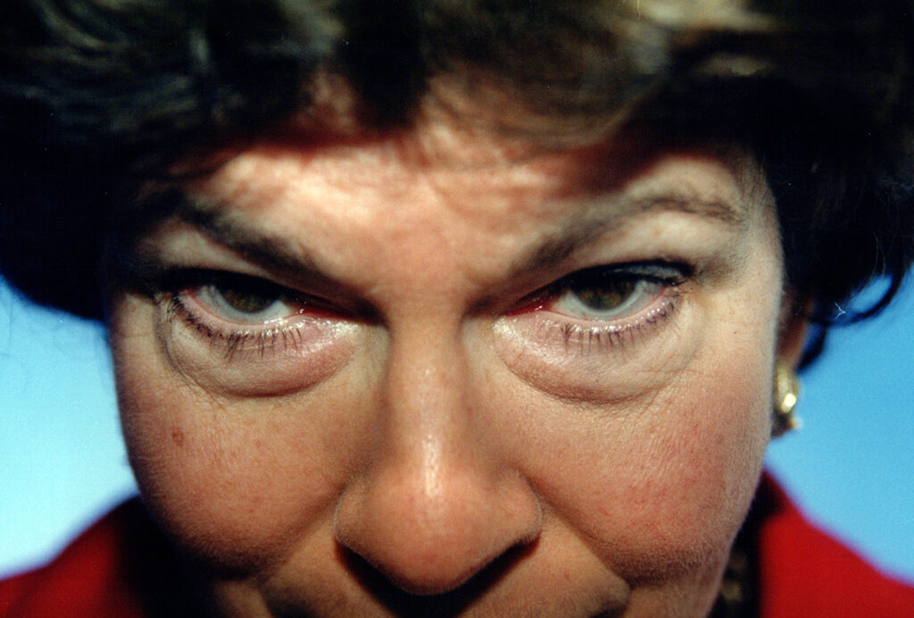 Before Image: Blepharoplasty - front