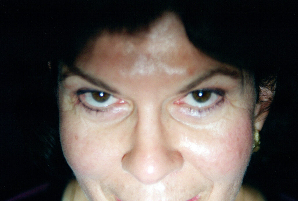 After Image: Blepharoplasty - front