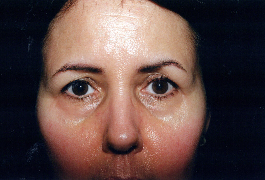 Before Image: Blepharoplasty - front