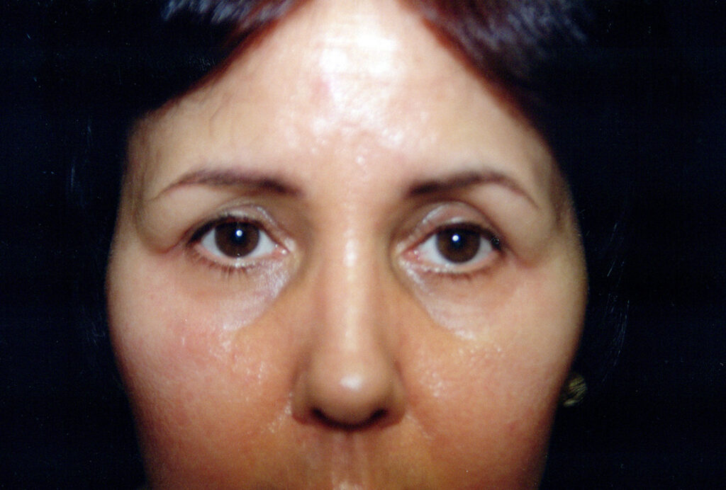 After Image: Blepharoplasty - front