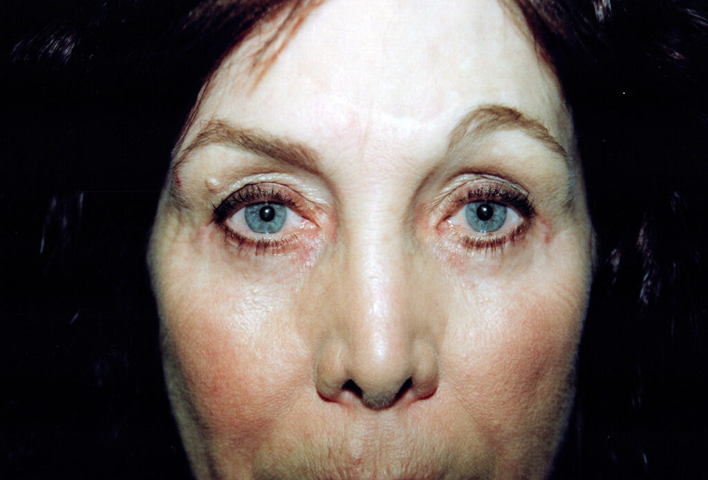 After Image: Blepharoplasty - front