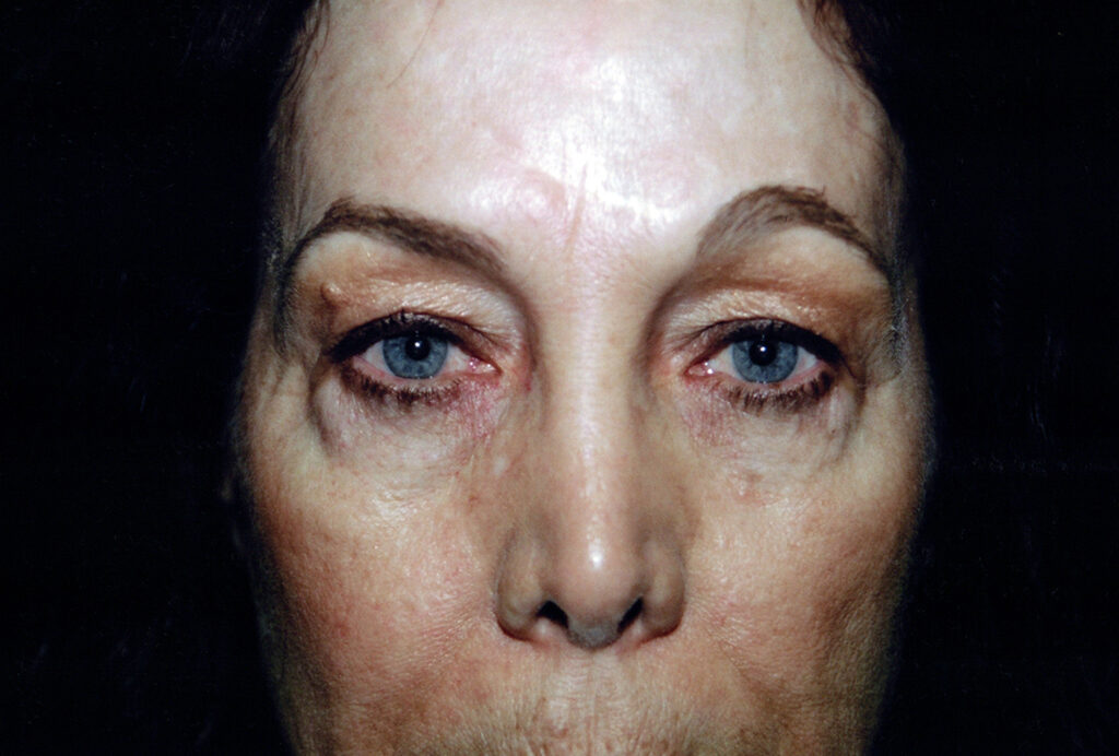 Before Image: Blepharoplasty - front