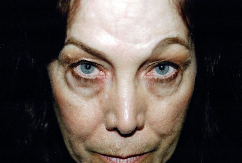 Before Image: Blepharoplasty - front