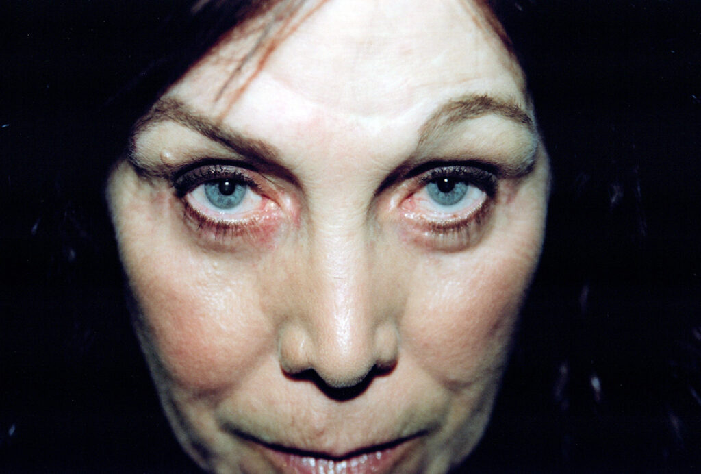 After Image: Blepharoplasty - front