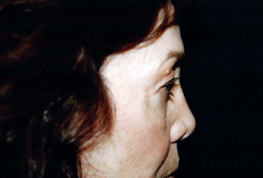 Before Image: Blepharoplasty - right-side