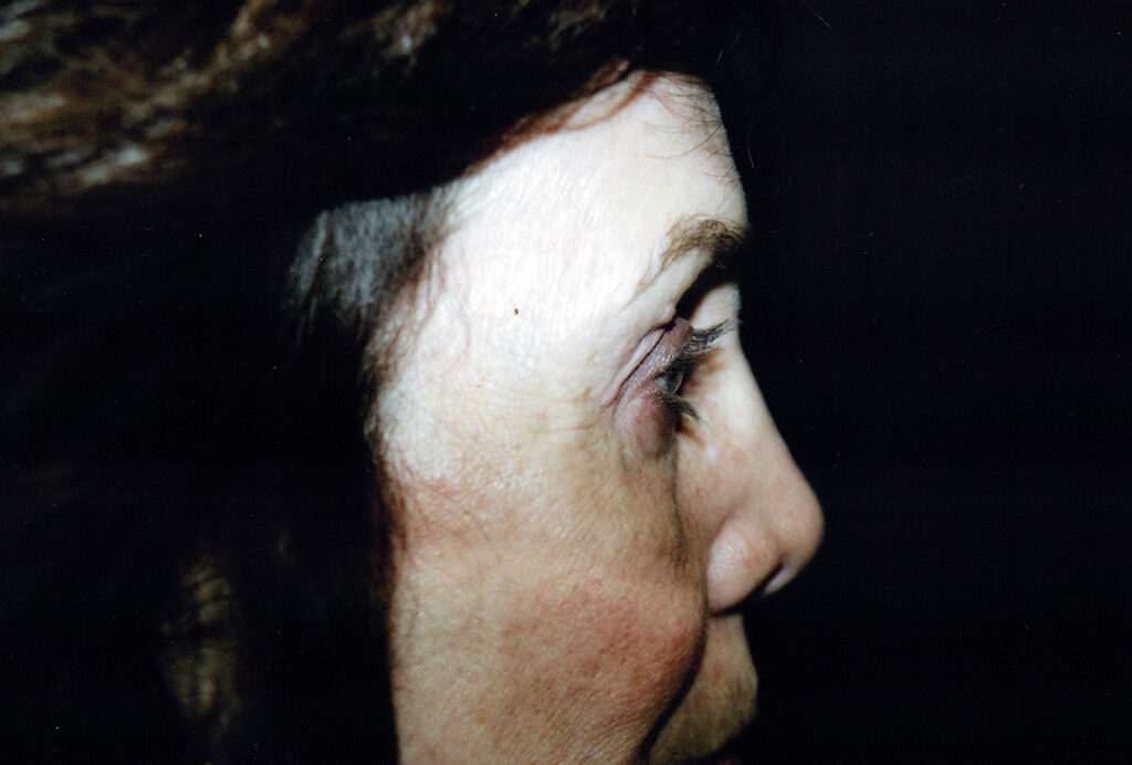 After Image: Blepharoplasty - right-side