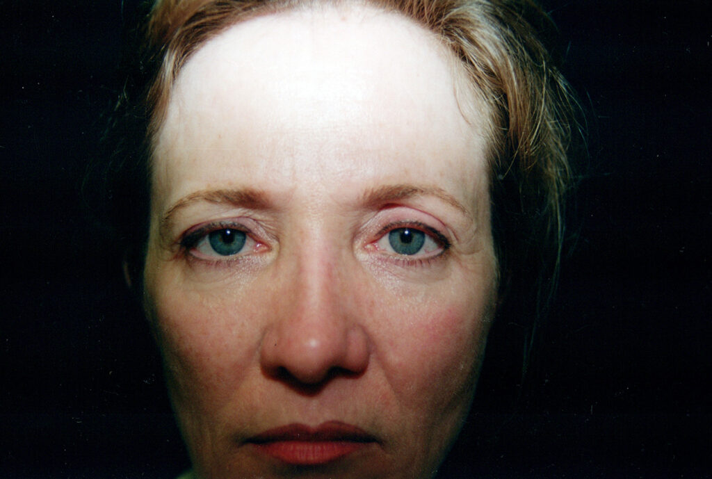 Before Image: Blepharoplasty - front