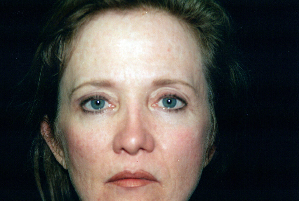 After Image: Blepharoplasty - front