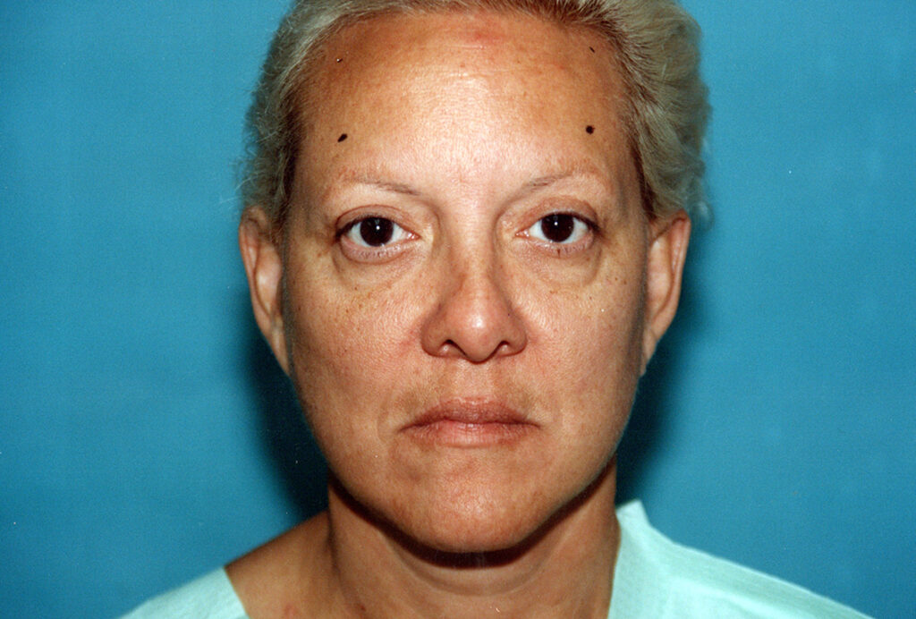 Before Image: Blepharoplasty - front