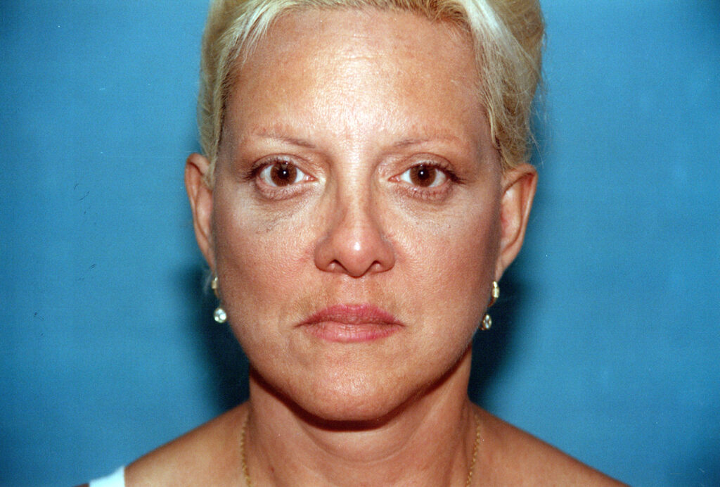 After Image: Blepharoplasty - front