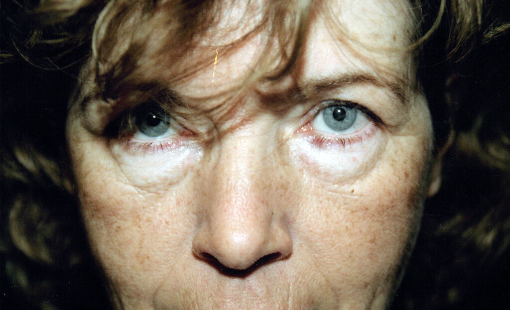 Before Image: Blepharoplasty - front