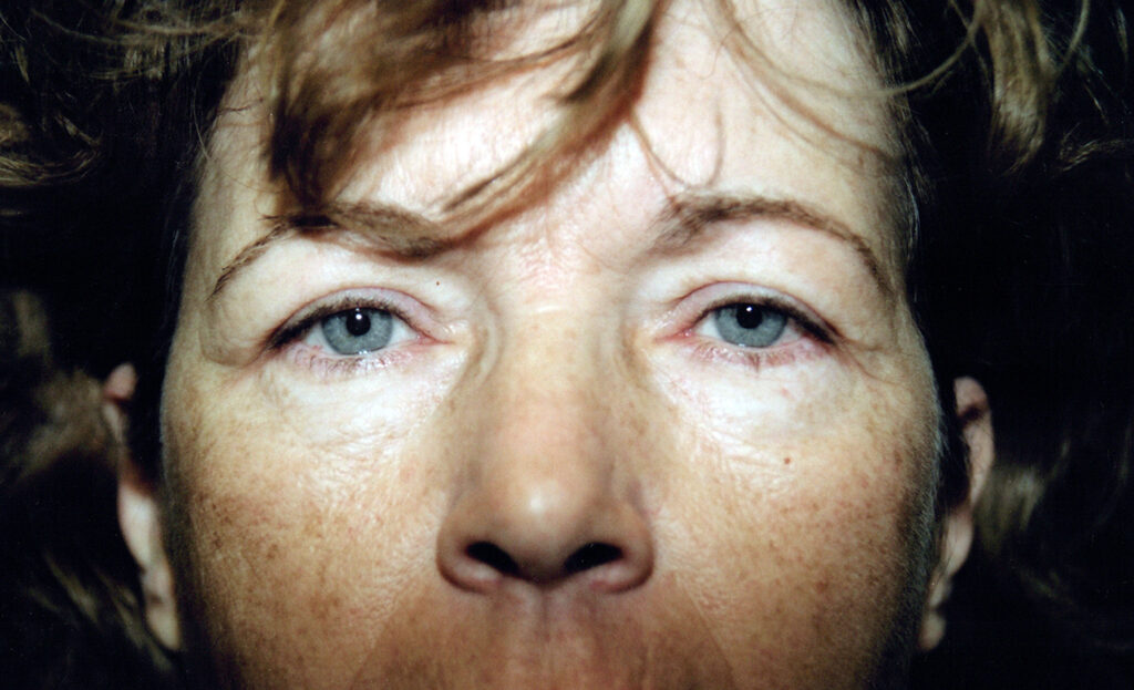 After Image: Blepharoplasty - front