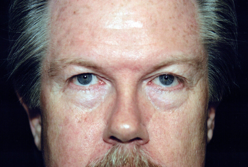 Before Image: Blepharoplasty - front