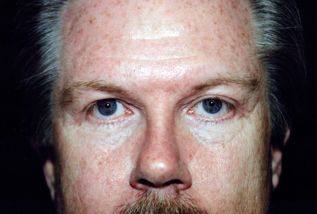 After Image: Blepharoplasty - front