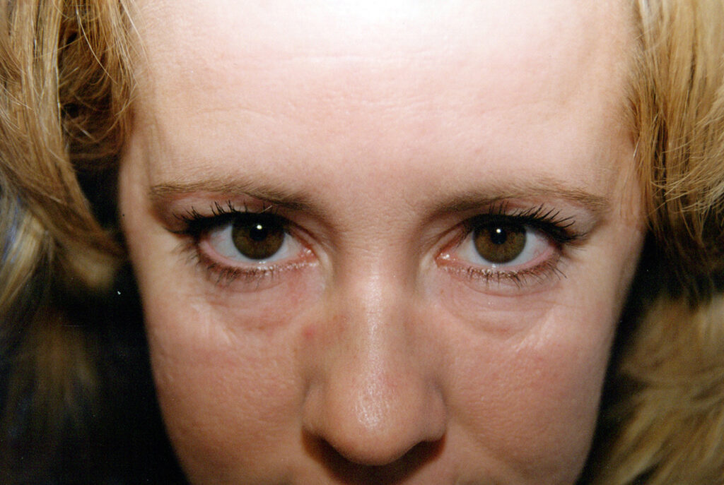 Before Image: Blepharoplasty - front