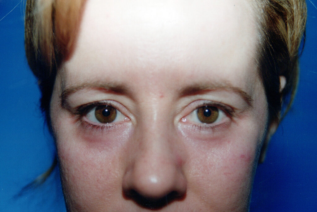 After Image: Blepharoplasty - front