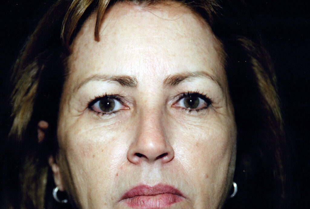 Before Image: Blepharoplasty - front
