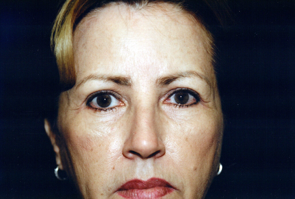 After Image: Blepharoplasty - front