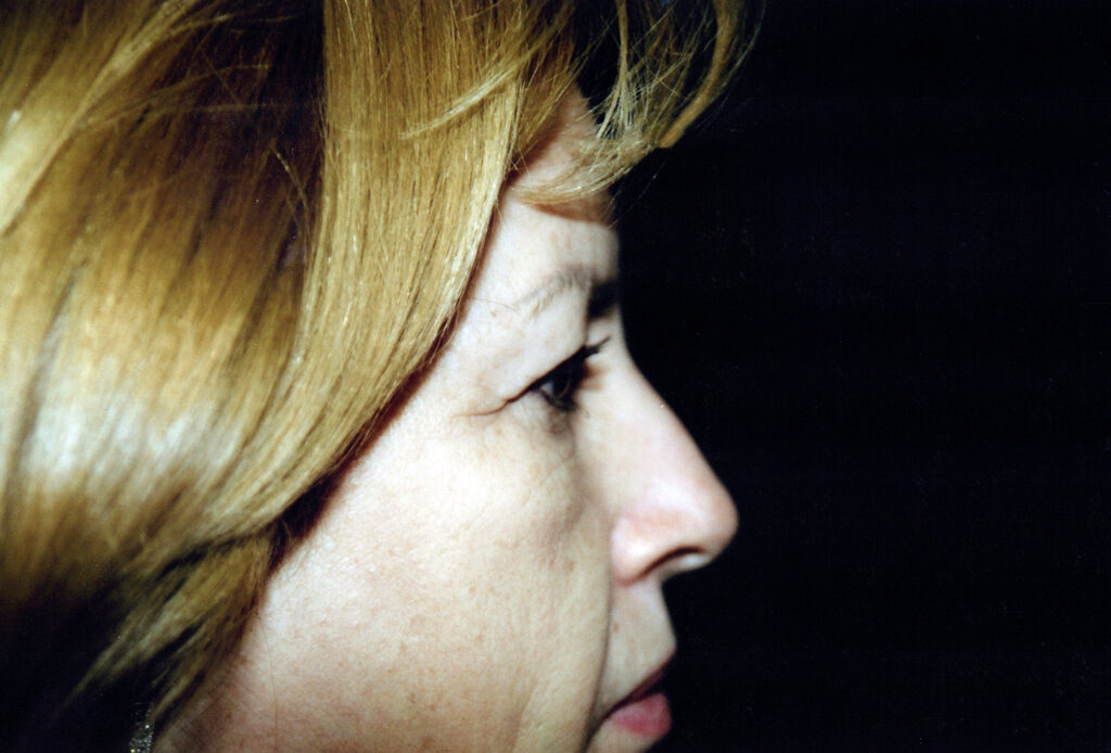 Before Image: Blepharoplasty - right-side
