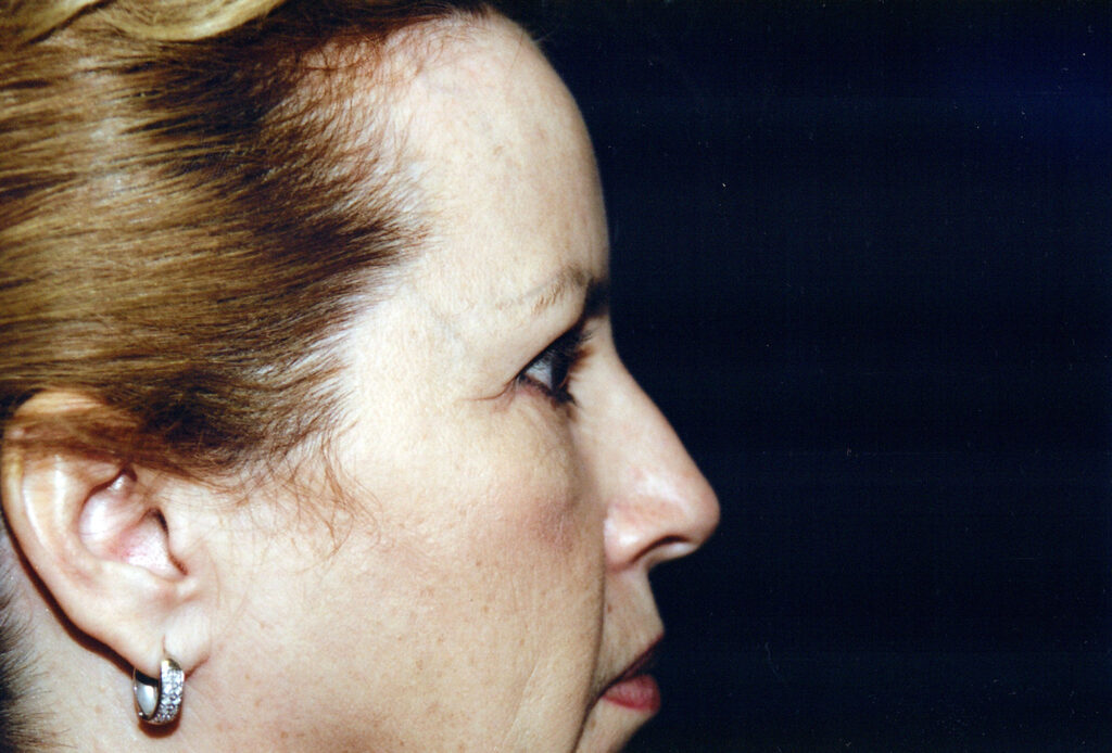 After Image: Blepharoplasty - right-side