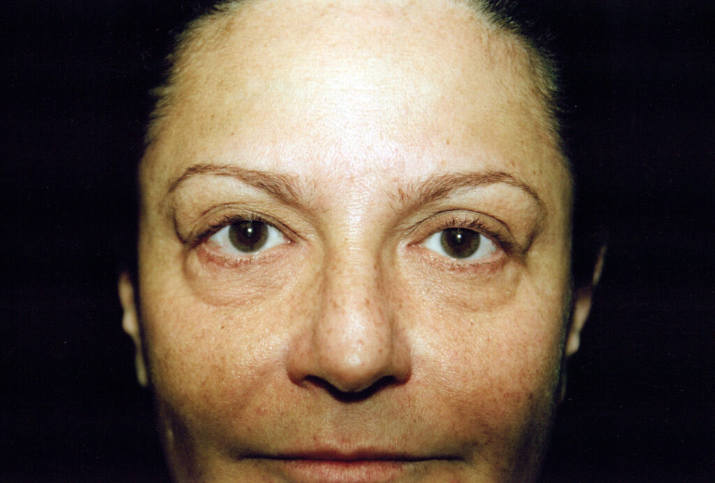 Before Image: Blepharoplasty - front