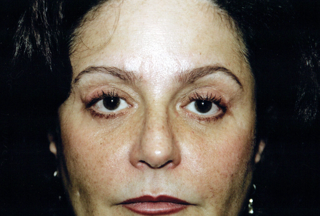 After Image: Blepharoplasty - front
