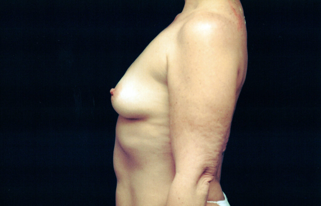 Before Image: Breast Augmentation - left-side