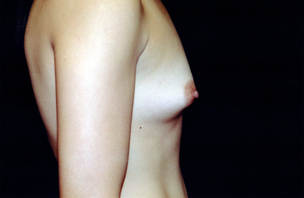 Before Image: Breast Augmentation - right-side