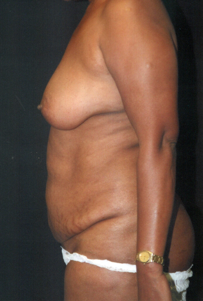 Before Image: Breast Augmentation - left-side