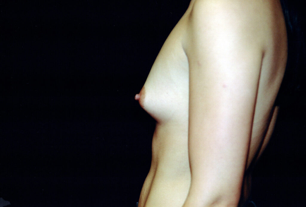 Before Image: Breast Augmentation - left-side
