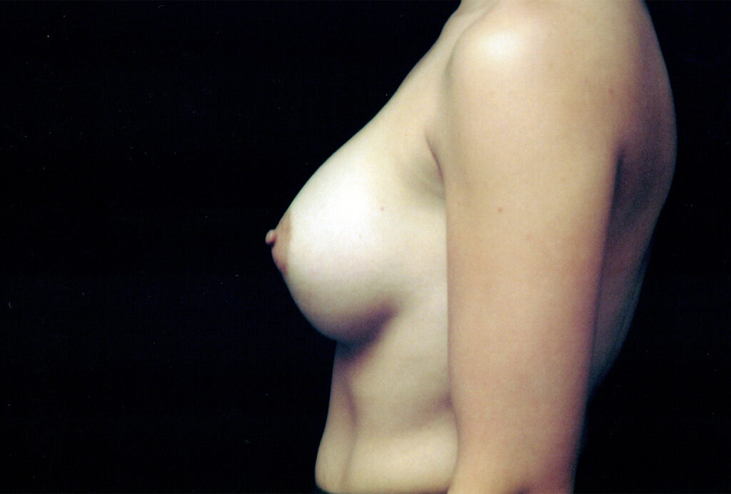 After Image: Breast Augmentation - left-side