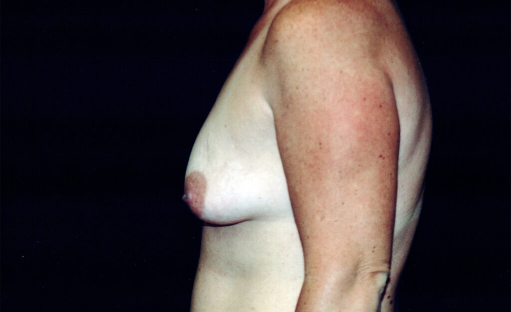 Before Image: Breast Augmentation - left-side