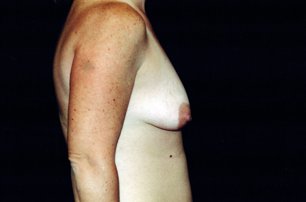 Before Image: Breast Augmentation - right-side