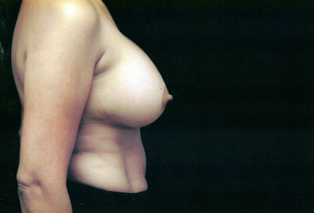 After Image: Breast Augmentation - right-side