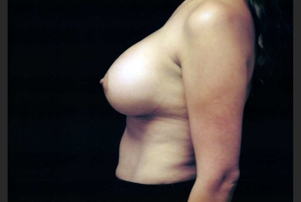 After Image: Breast Augmentation - left-side