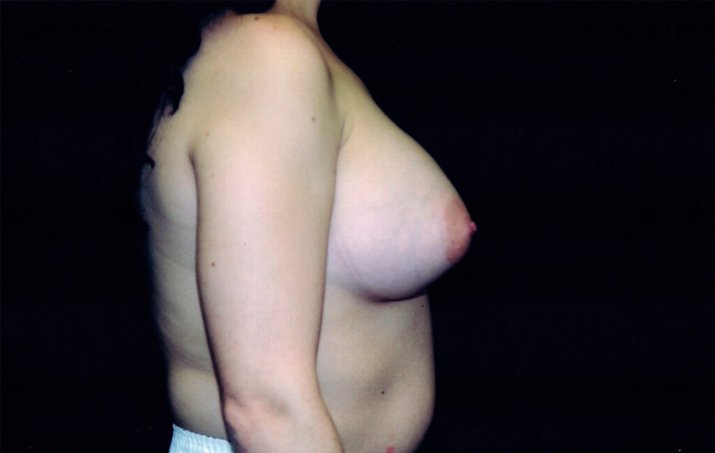 After Image: Breast Augmentation - right-side