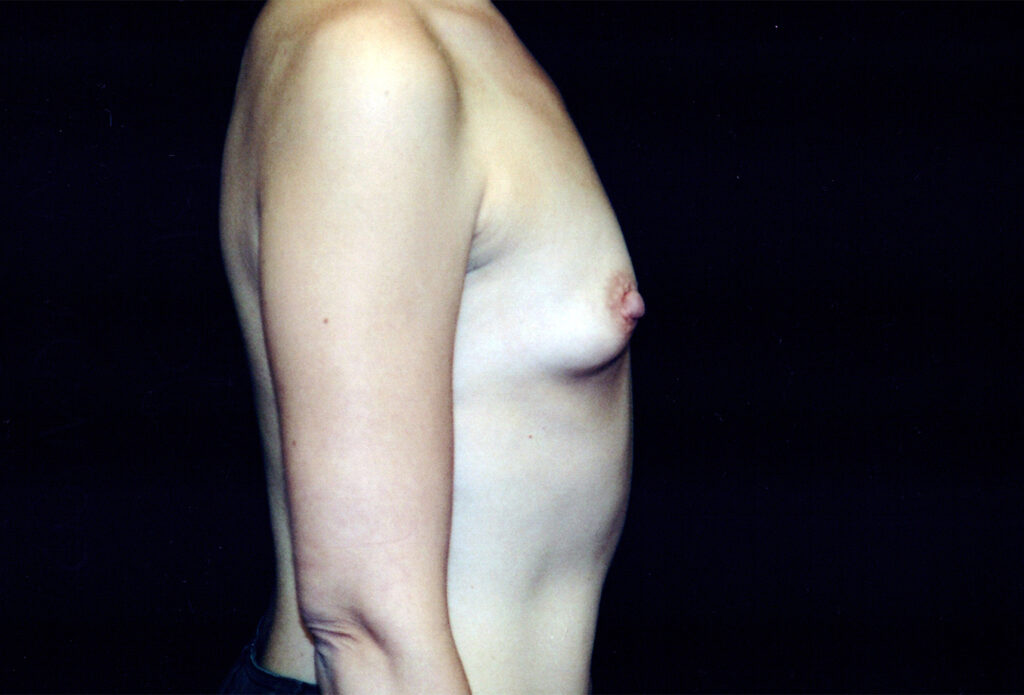 Before Image: Breast Augmentation - right-side