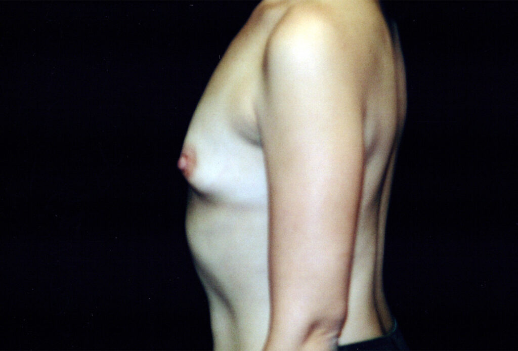 Before Image: Breast Augmentation - left-side