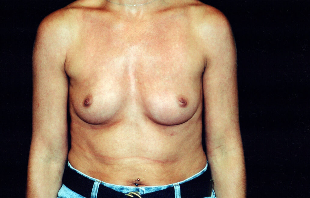 Before Image: Breast Augmentation - front