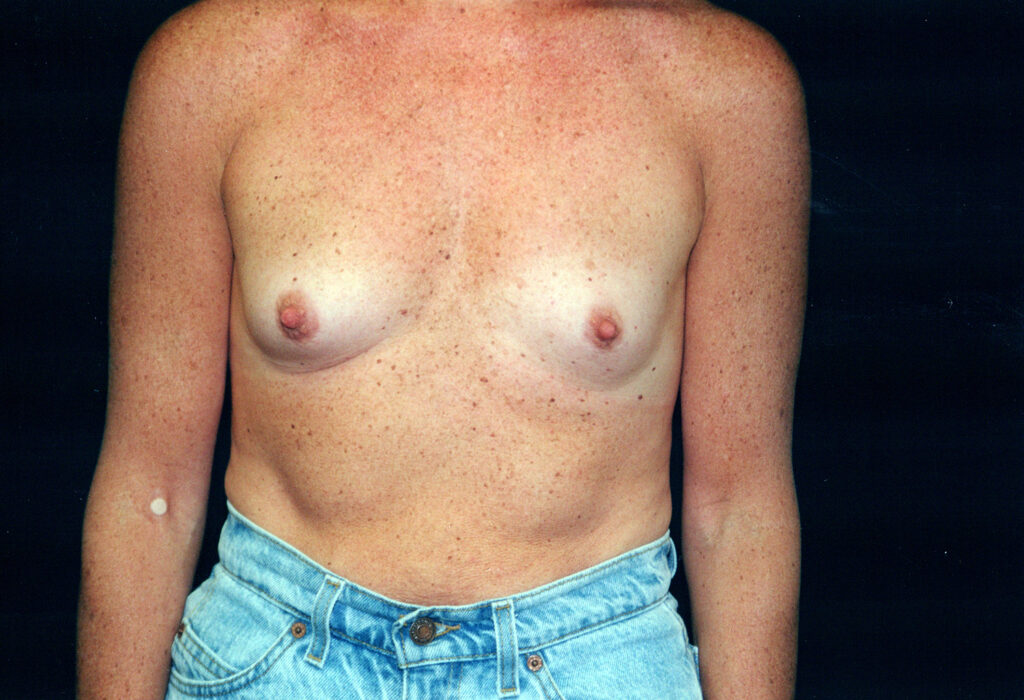 Before Image: Breast Augmentation - front