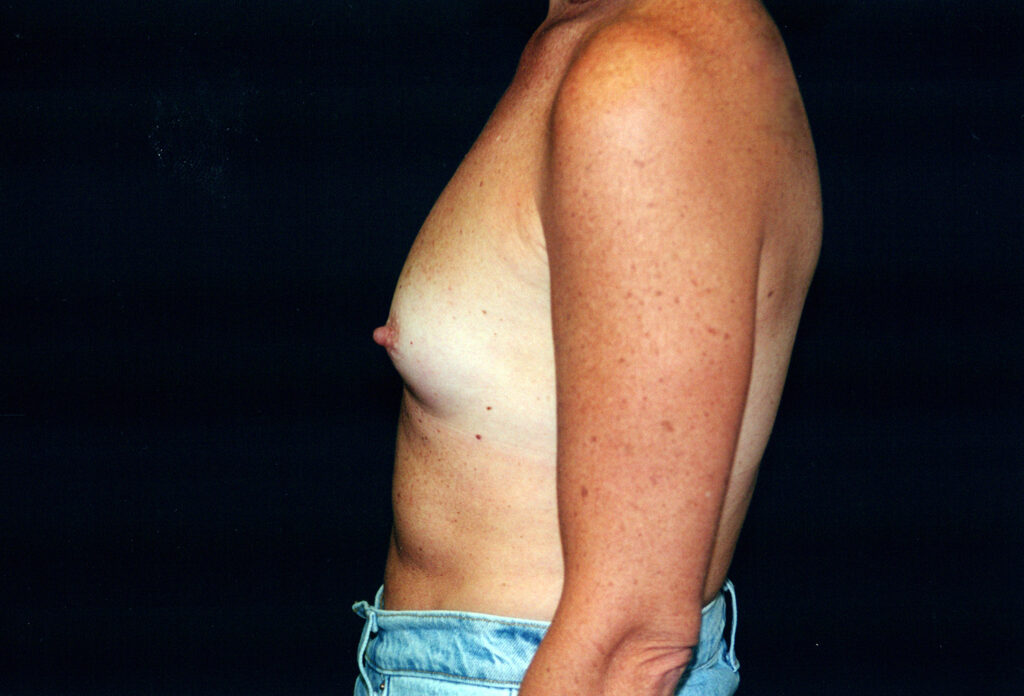 Before Image: Breast Augmentation - left-side