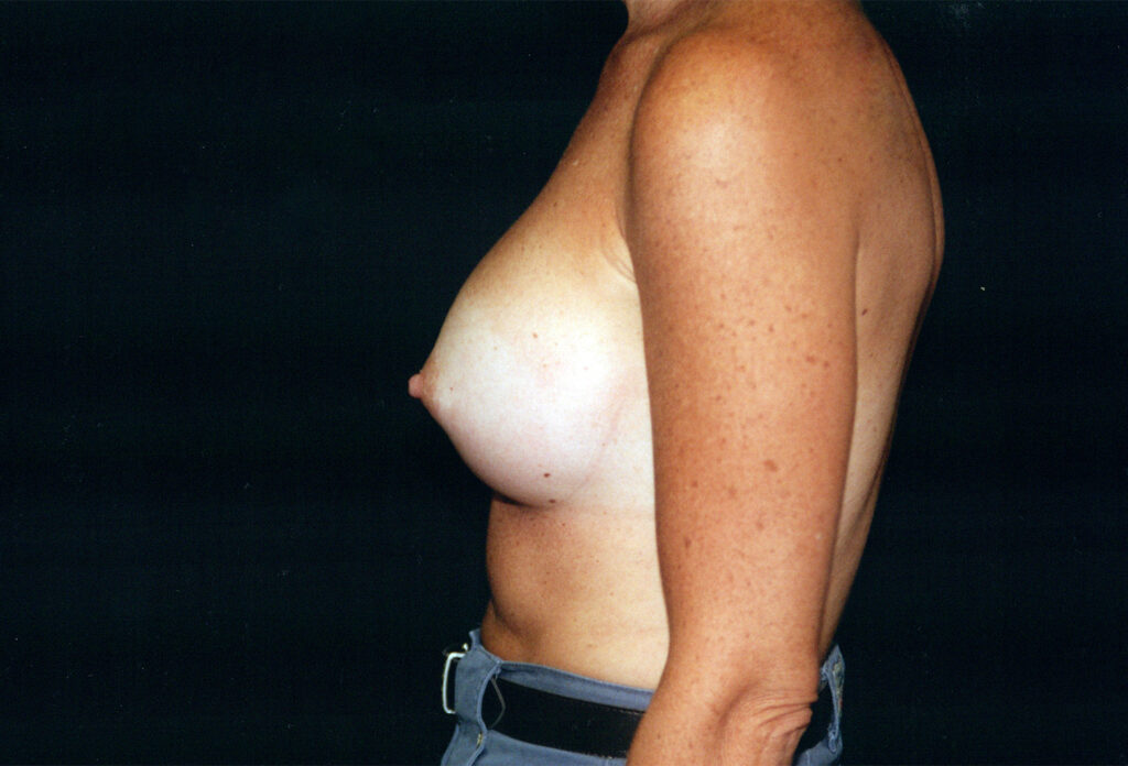 After Image: Breast Augmentation - left-side