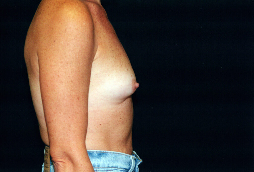 Before Image: Breast Augmentation - right-side