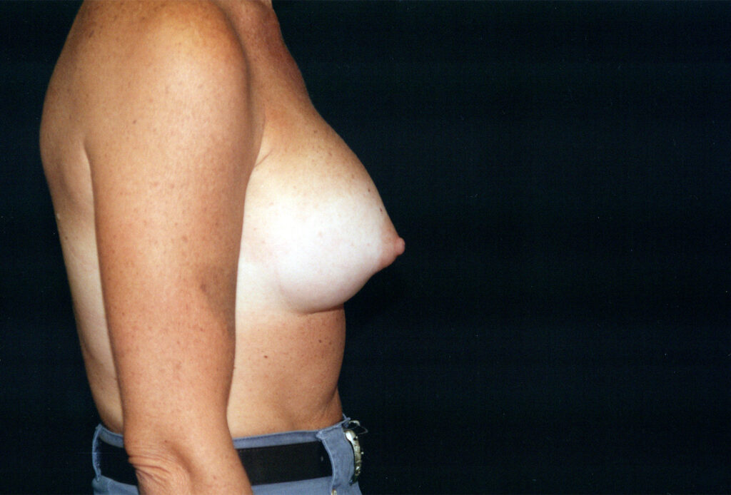 After Image: Breast Augmentation - right-side