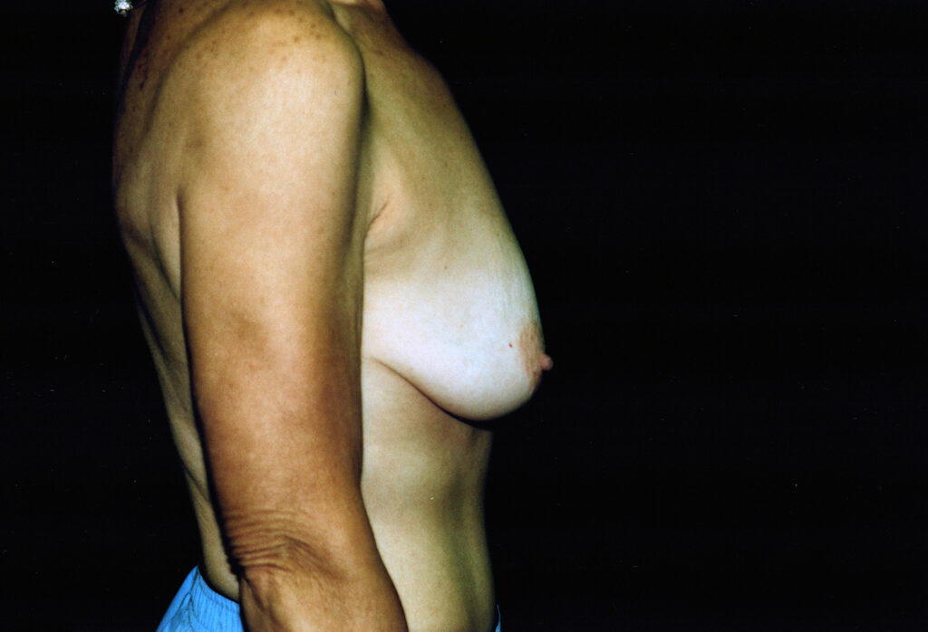Before Image: Breast Lift with Implants - right-side