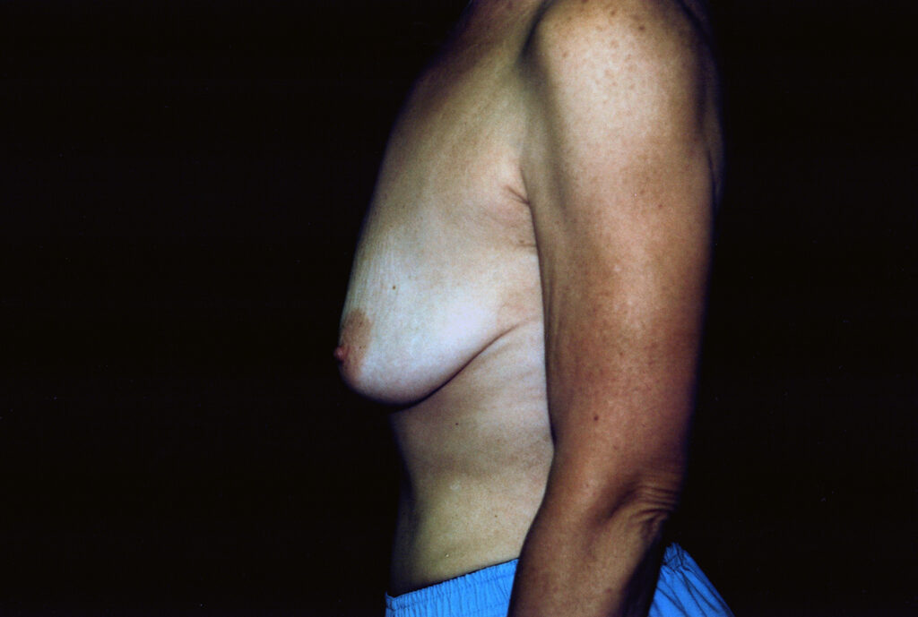 Before Image: Breast Lift with Implants - left-side